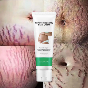 Stretch Mark Removal Cream80324