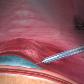 Injection Infusion Needle97514
